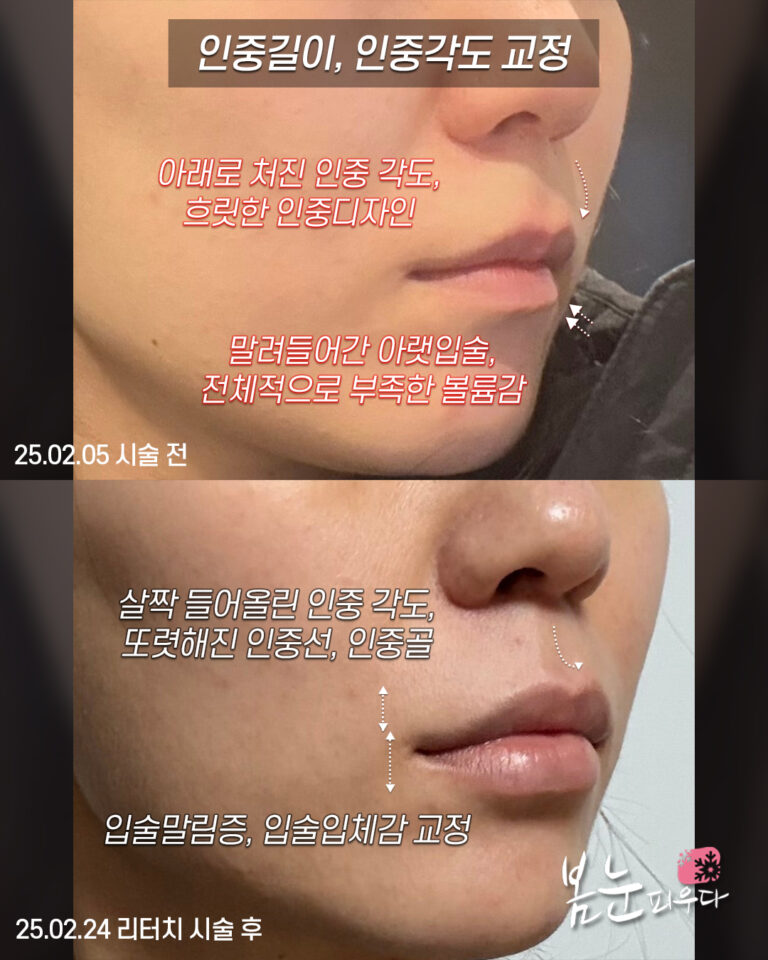 입술필러 인중길이, 인중각도 교정 후기