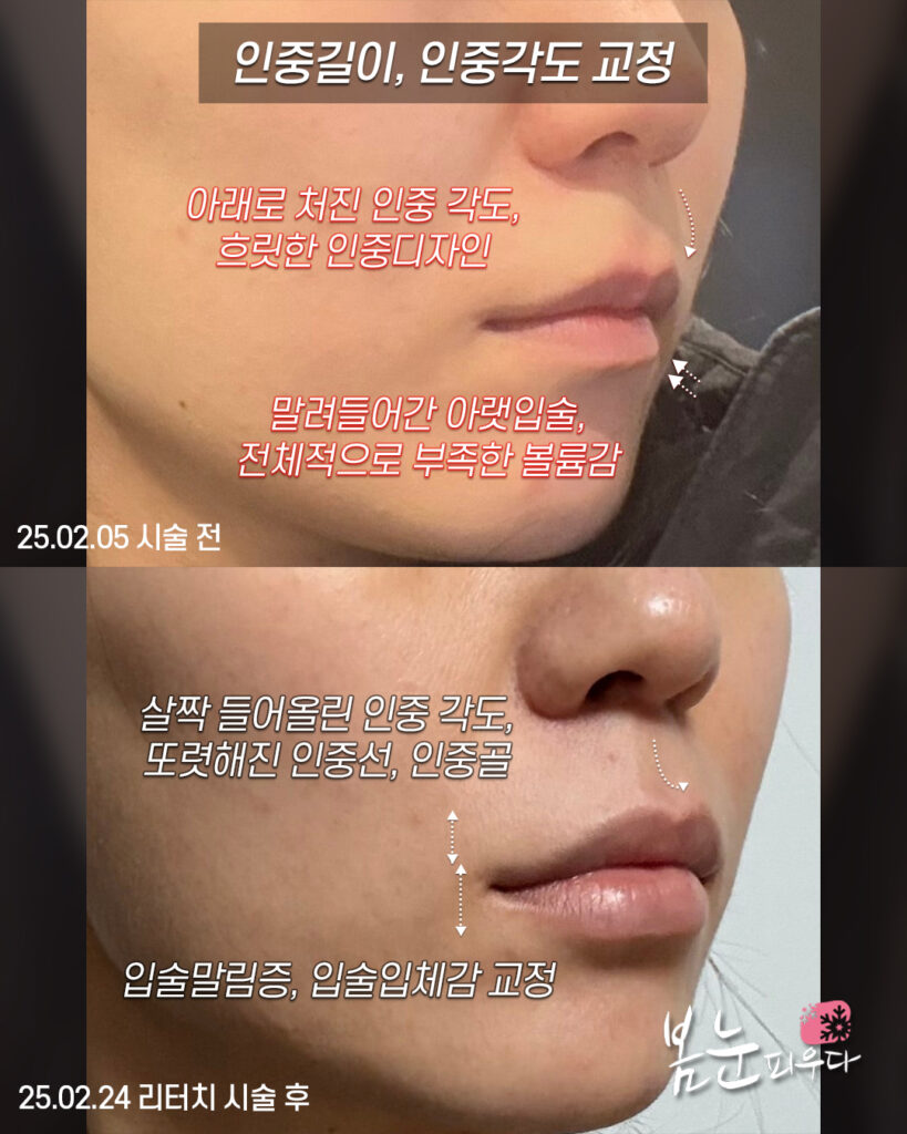 입술필러 인중길이, 인중각도 교정 후기