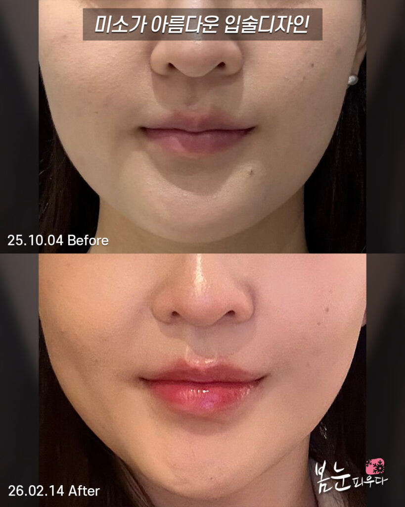 웃을 때 더 아름다운 입술필러후기