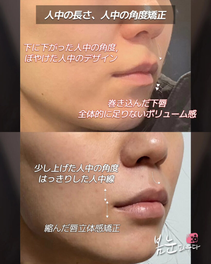 唇ヒアルロン酸