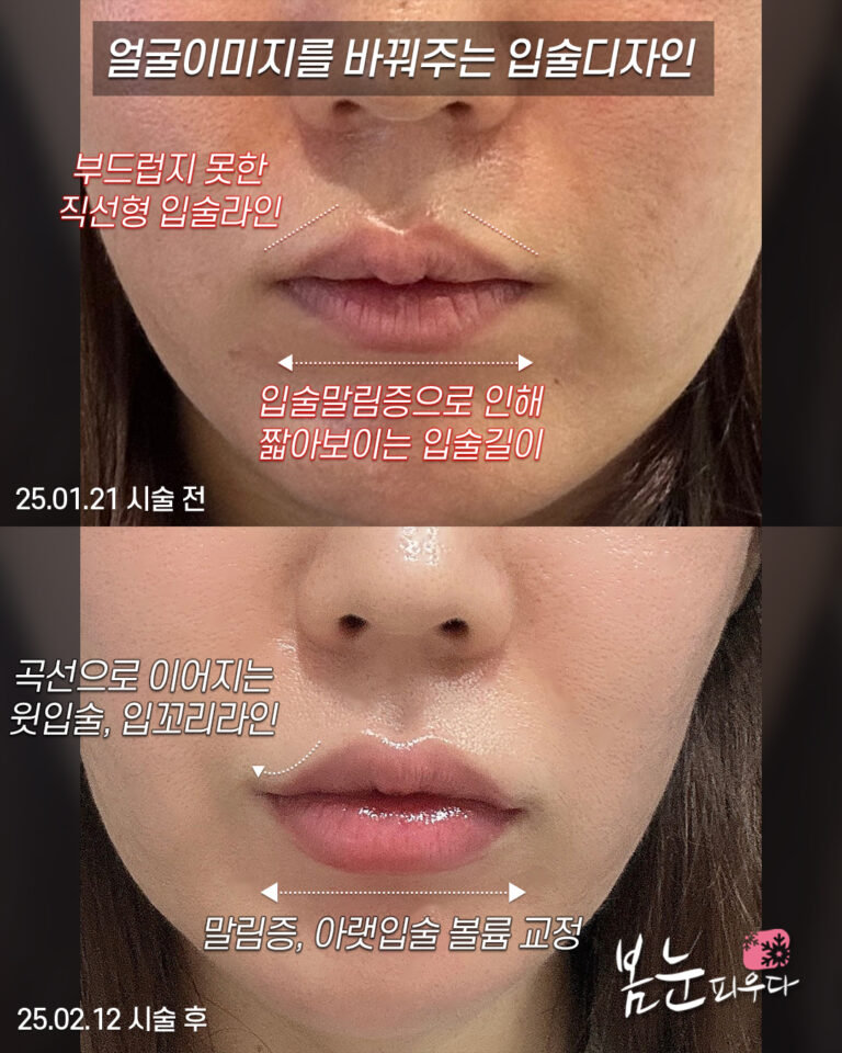 윗입술필러 디자인