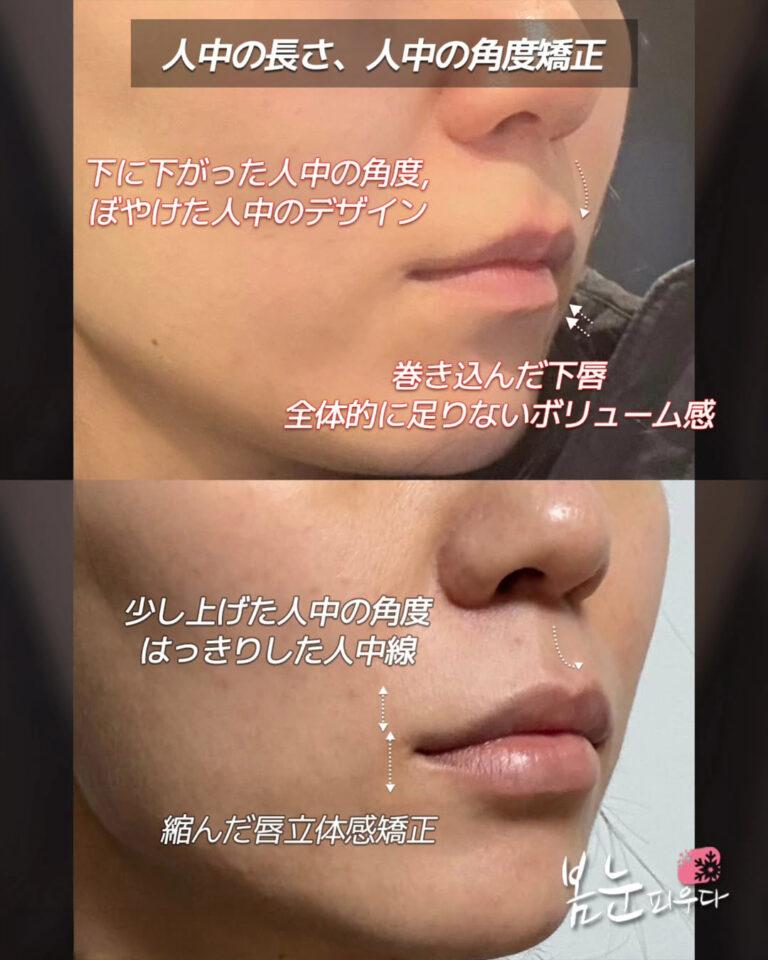 唇ヒアルロン酸