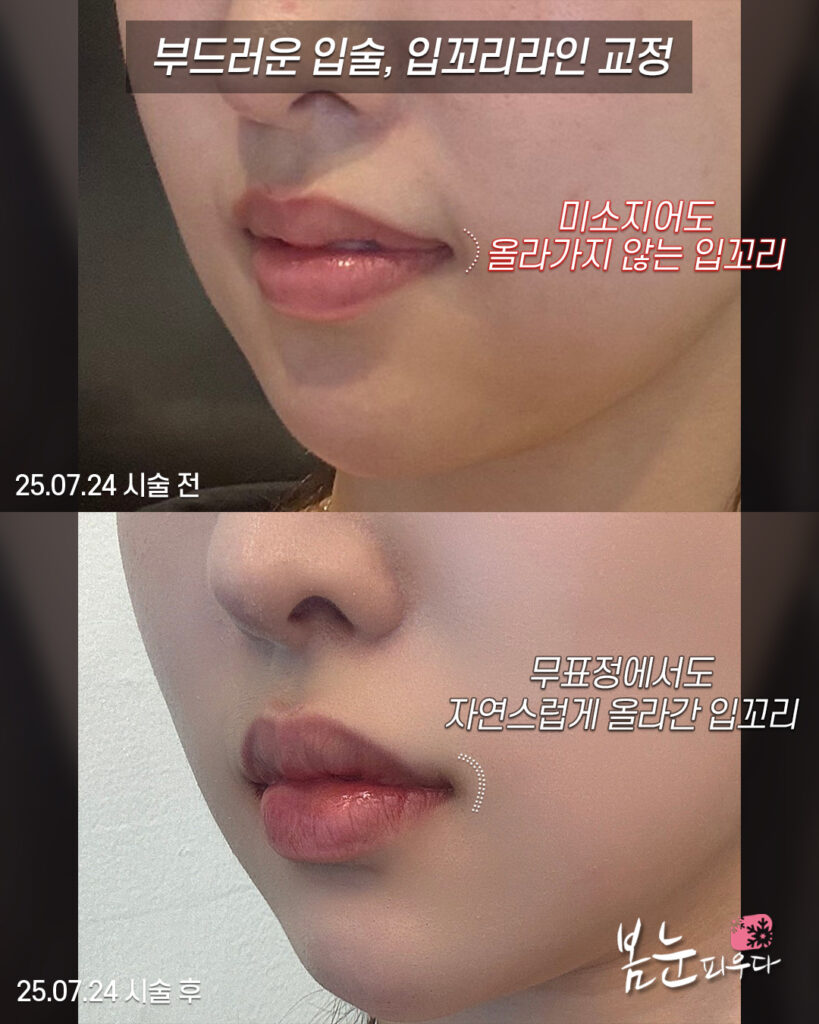 자연스러운 입술필러 디자인