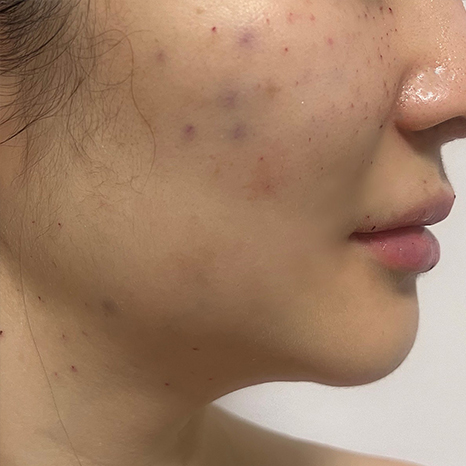 리쥬란 후 주사바늘자국, 멍