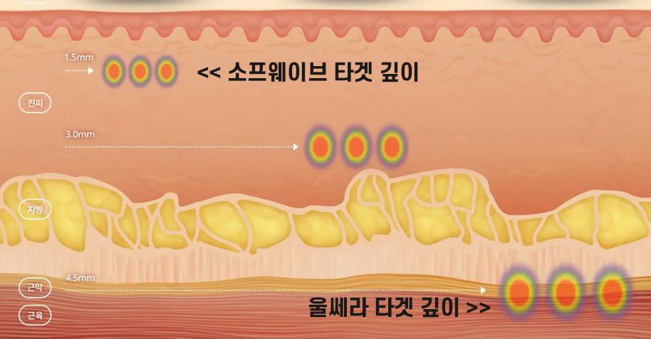 소프웨이브와 울쎄라의 타겟층