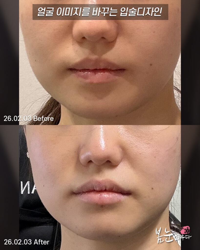 윗입술필러 디자인