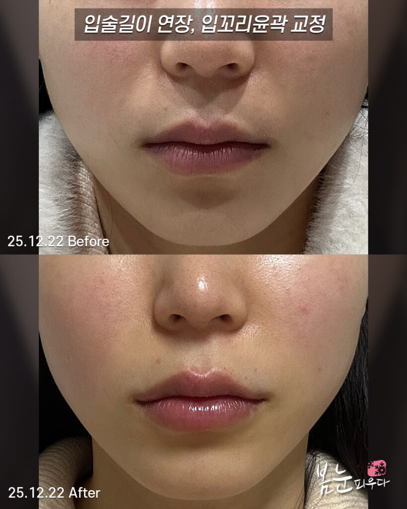입꼬리필러를 통한 입술길이 연장
