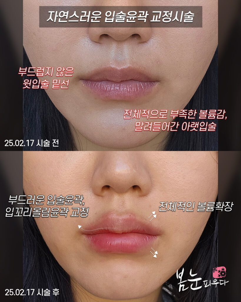 자연스러운 윗입술필러