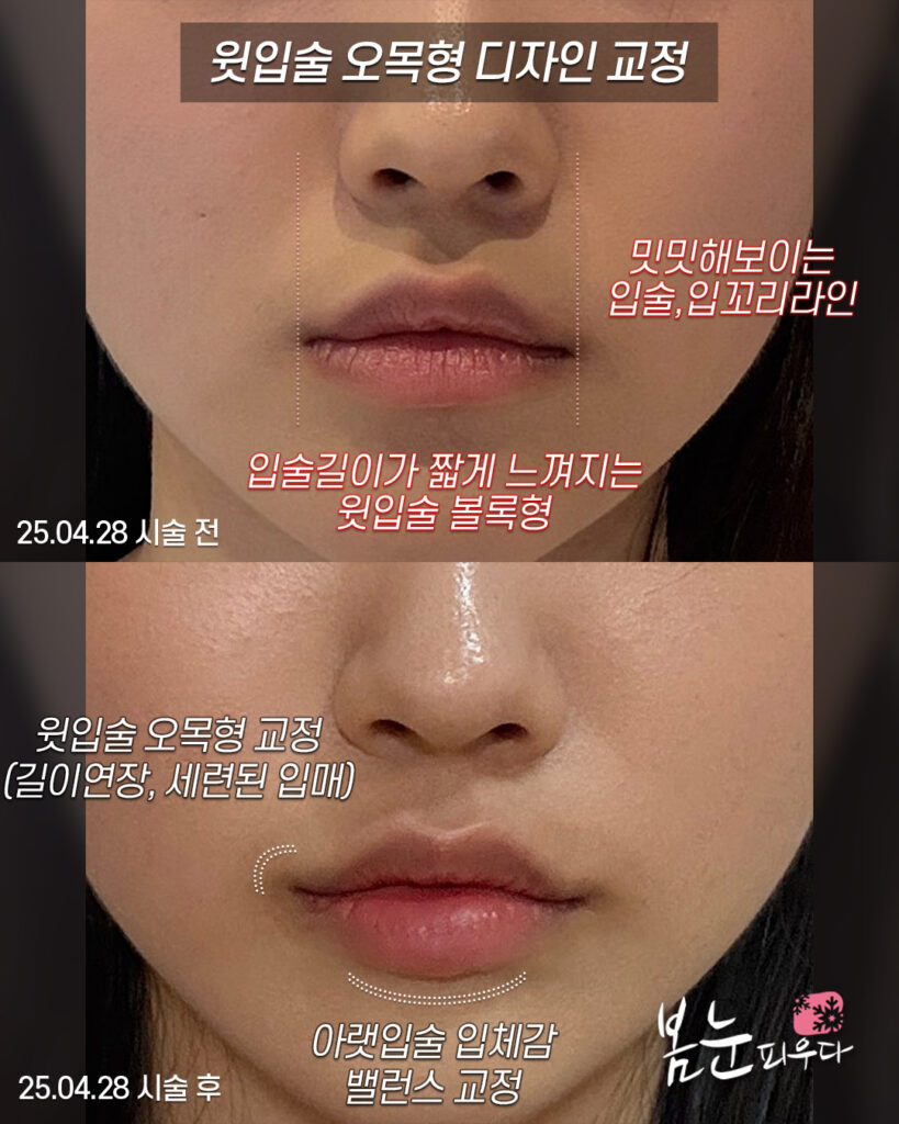 윗입술필러 오목형 디자인
