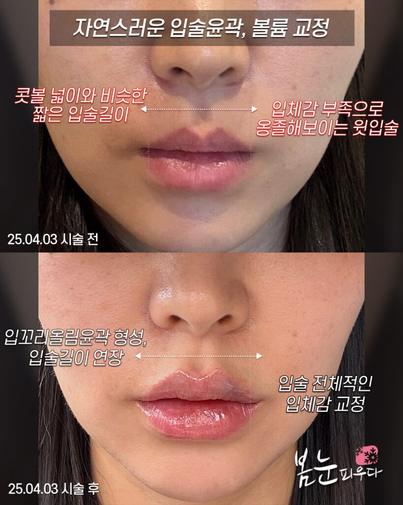 입꼭지 강조된 경우 윗입술필러 디자인