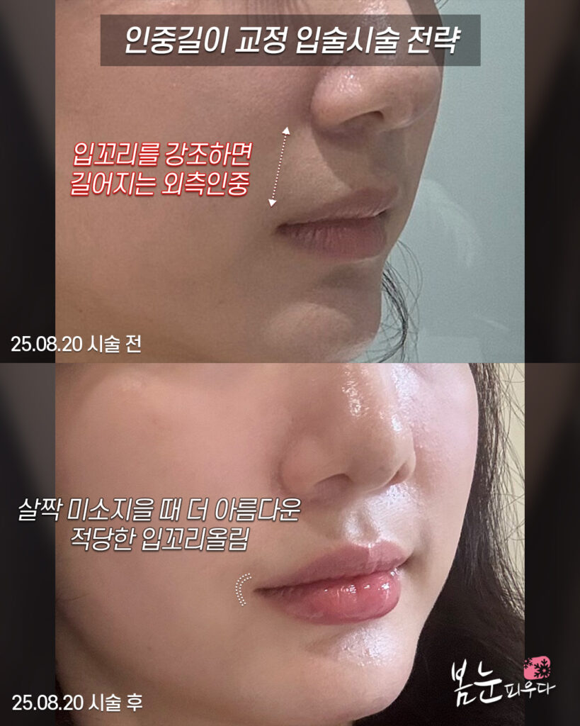 입꼬리필러와 인중길이의 상관관계