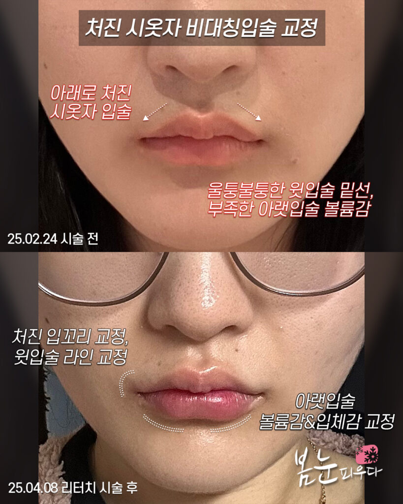 입술비대칭 교정시술 후기