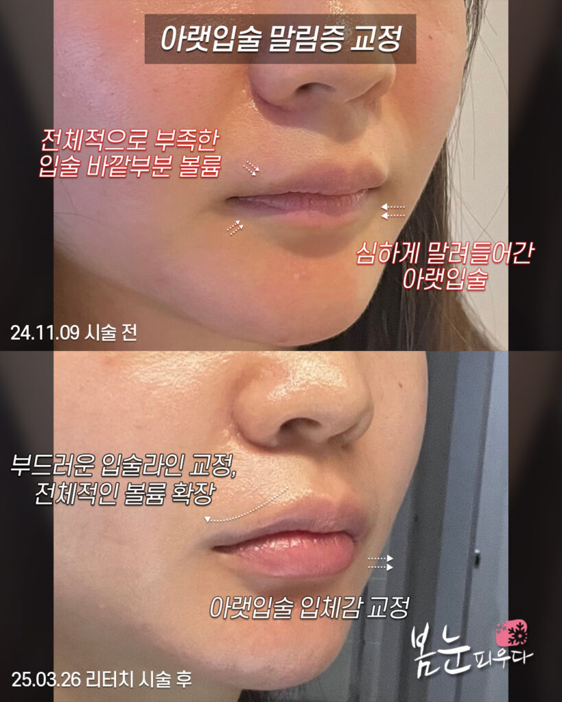 아랫입술필러_말림증 교정