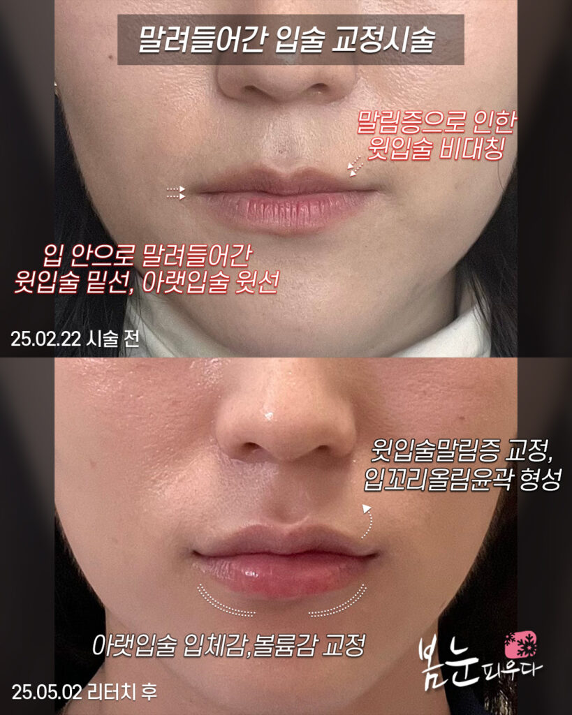 아랫입술필러_볼륨감 교정