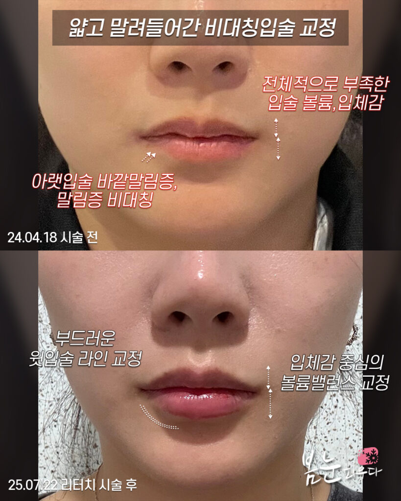 아랫입술필러_직선형윗선