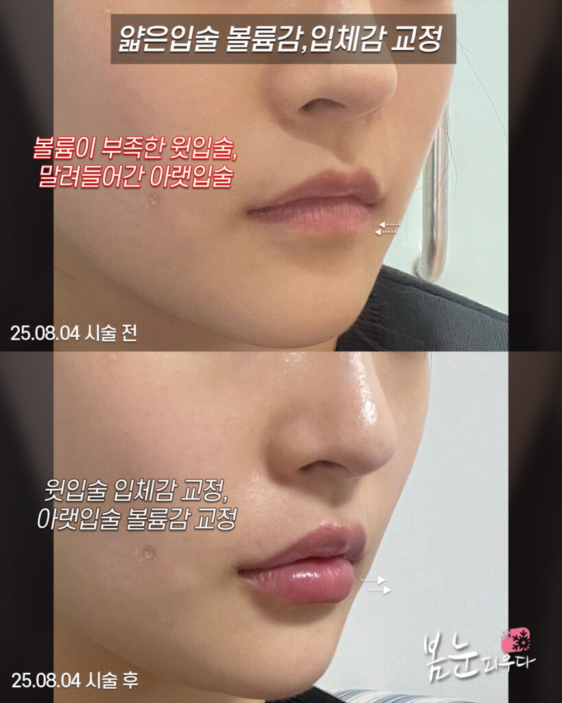 아랫입술필러_직성형윗선2